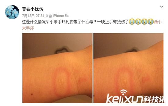 小米手環(huán)燙傷用戶？ 真假難辨誰(shuí)之過(guò)